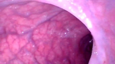 My colon sigma tract with veins